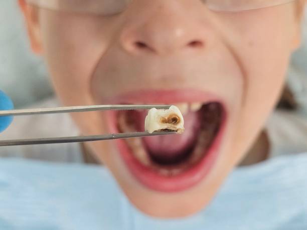 Best Chipped Tooth Repair Near Me  in Lake Meade, PA